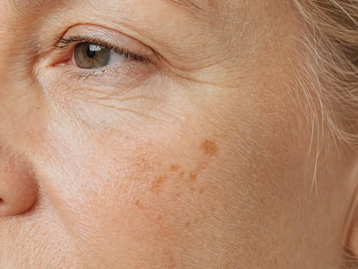 Sun spots and age spots on the face