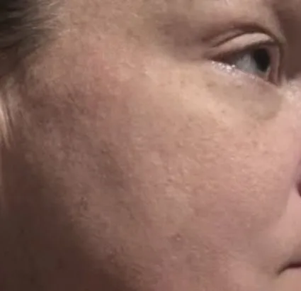 After 1 session: BBL photofacial, sun damage at Vero Beach Medical Spa