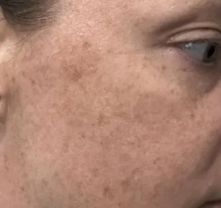 Before: BBL photofacial, sun damage at Vero Beach Medical Spa