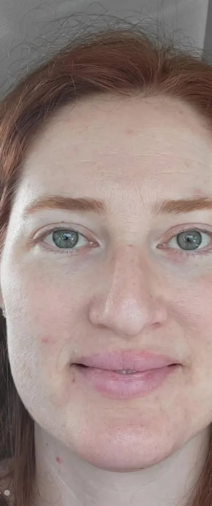 10 days after: BBL photofacial, first treatment, sun damage at Vero Beach Medical Spa