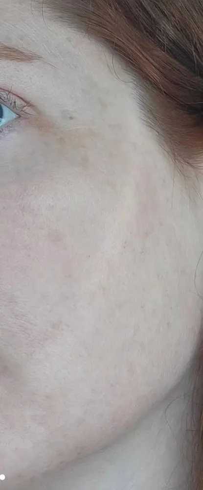 10 days after: BBL photofacial, first treatment at Vero Beach Medical Spa