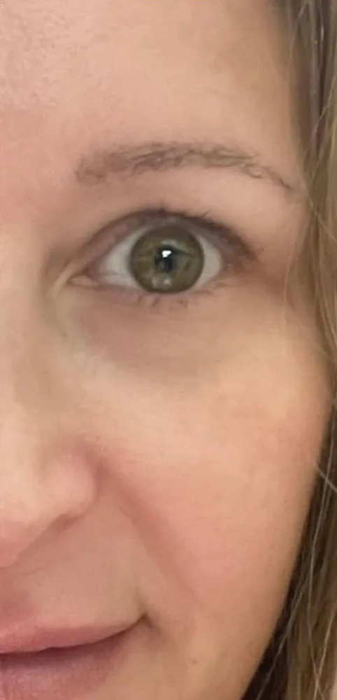 After: Xeomin, crow's feet and under-eye lines at Vero Beach Medical Spa