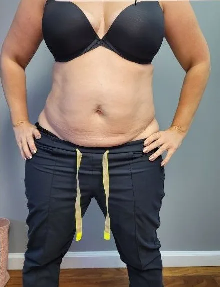 Before: EmSculpt Neo, abdomen at Vero Beach Medical Spa