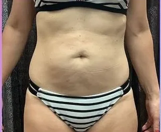 After: EmSculpt Neo, abdomen at Vero Beach Medical Spa