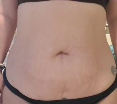 3 months after: EmSculpt Neo, abdomen, 6 treatments at Vero Beach Medical Spa