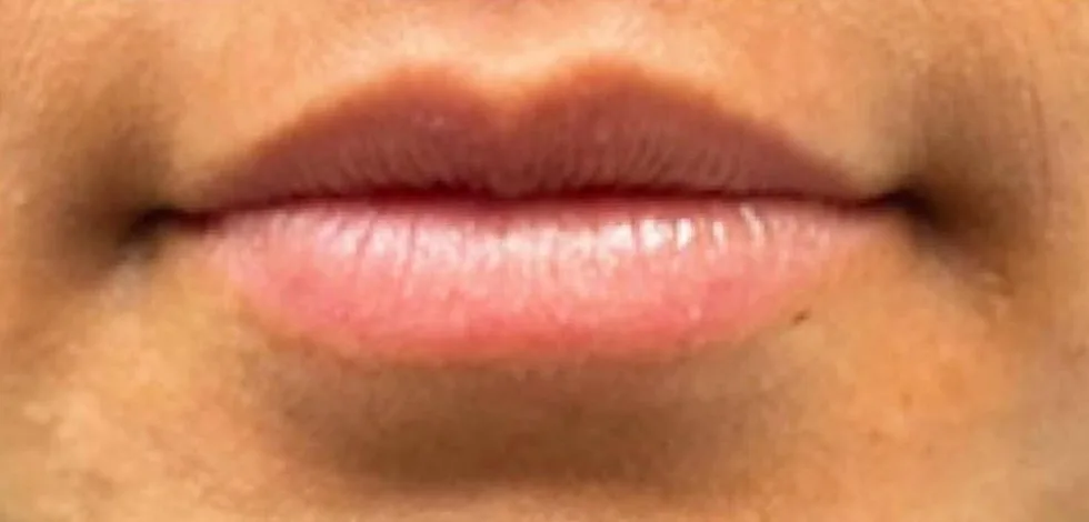 Before: Lip filler at Vero Beach Medical Spa
