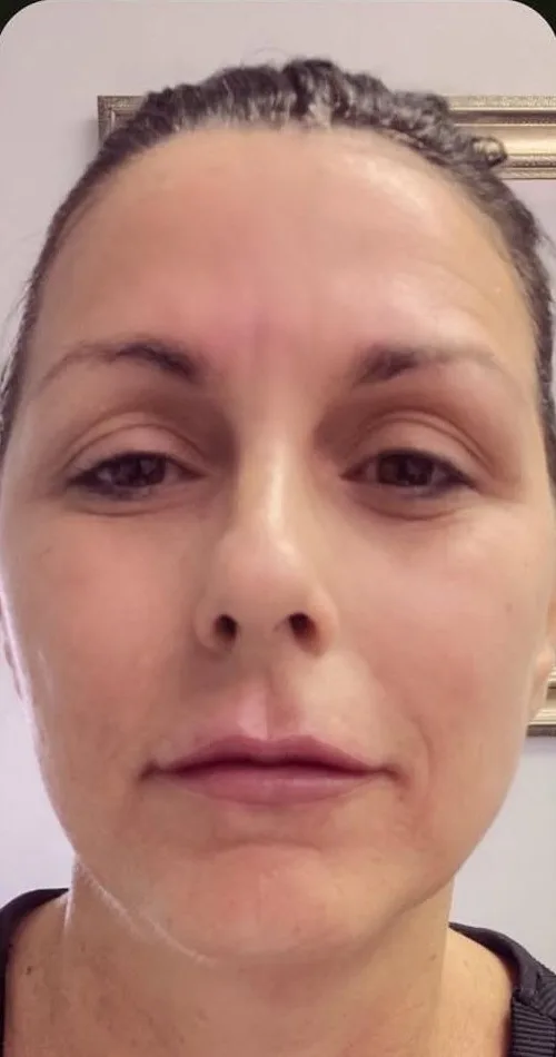 After: Lip and smile-line filler, full face at Vero Beach Medical Spa