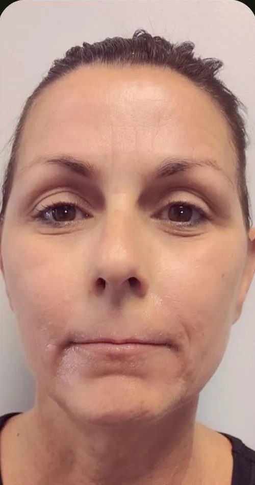 Before: Lip and smile-line filler, full face at Vero Beach Medical Spa