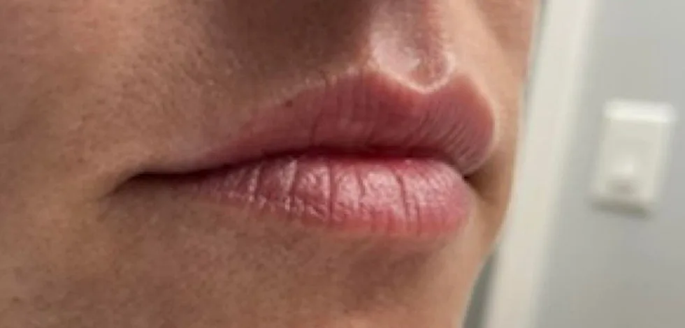 Before: Lip filler at Vero Beach Medical Spa