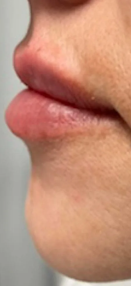 After: Lip filler, profile at Vero Beach Medical Spa