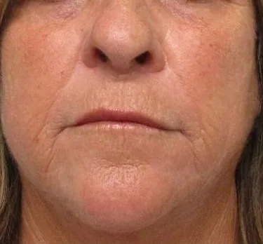 After 1 treatment: Morpheus8, lower face at Vero Beach Medical Spa