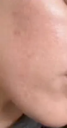 Post Morpheus: Morpheus8, client result, cheek texture at Vero Beach Medical Spa