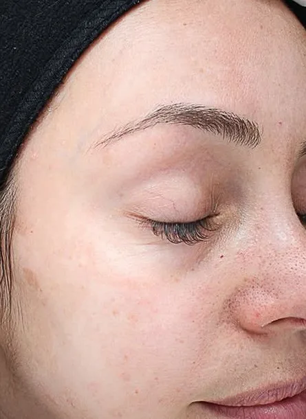 After: MOXI laser, pigment and tone at Vero Beach Medical Spa