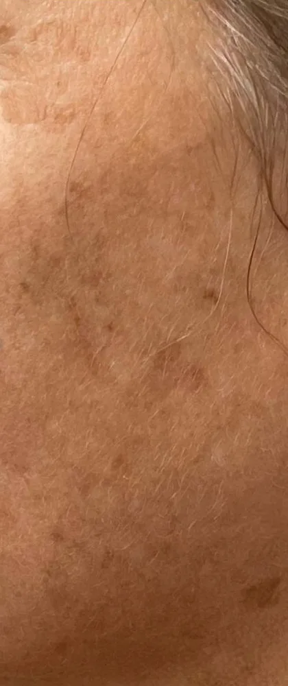 Before: MOXI + BBL, cheek at Vero Beach Medical Spa